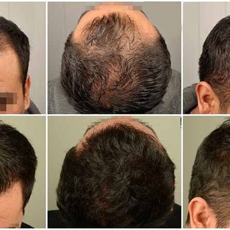GOOD HAIR TRANSPLANT CLINIC VS BAD HAIR TRANSPLANT CLINIC