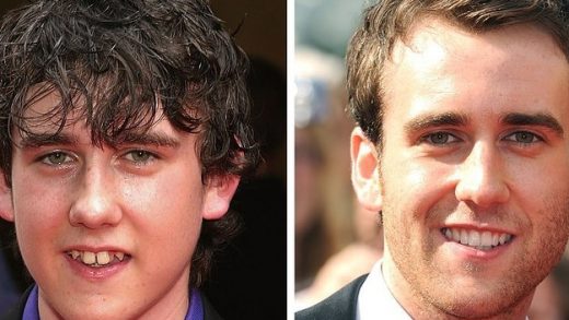 before and after celebrity teeth